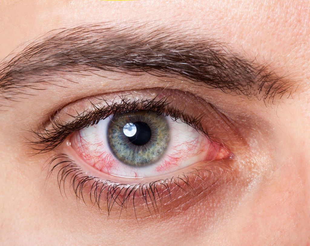 Đi tìm lời giải cho băn khoăn máu bầm ở mắt có nguy hiểm không