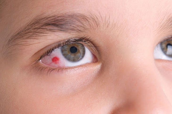 10+ cách làm tan máu bầm ở mắt tại nhà nhanh nhất