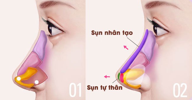 sau nâng mũi bị chảy máu