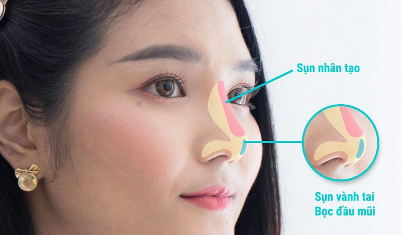 Nâng mũi sụn tai