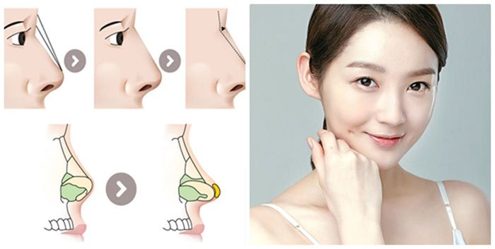 Nâng mũi uống sữa được không ?