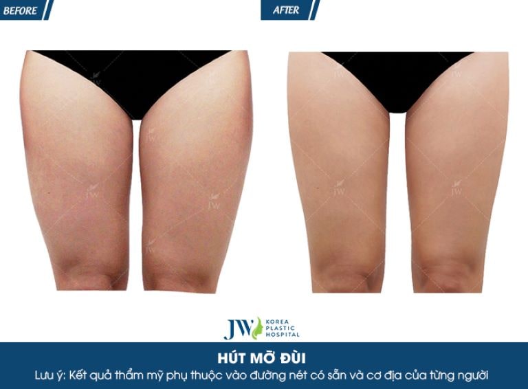 hút mỡ đùi hcm