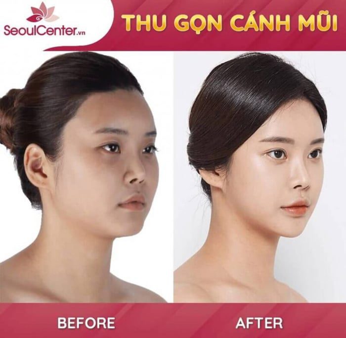thu gọn cánh mũi hcm