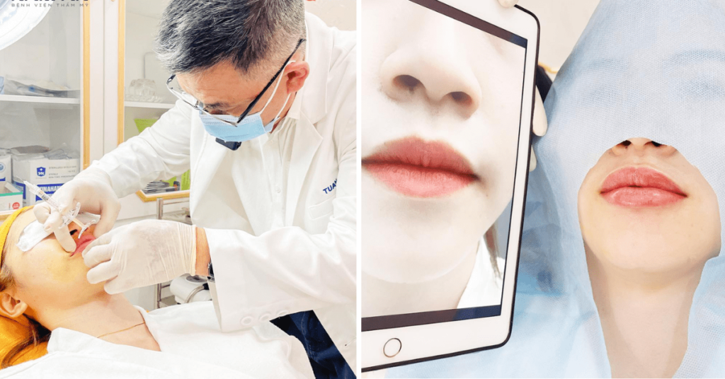 tiêm filler hcm
