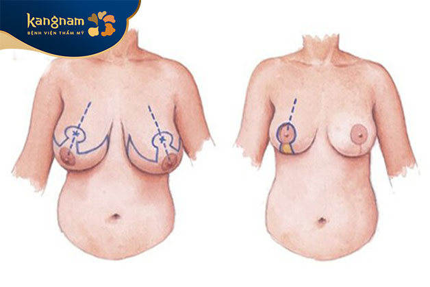 treo ngực sa trễ chảy xệ tphcm