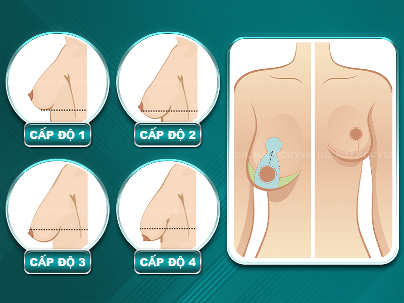 treo ngực sa trễ chảy xệ hcm