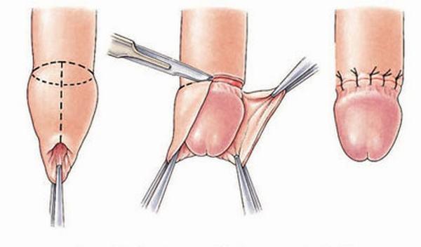 cắt bao quy đầu tphcm