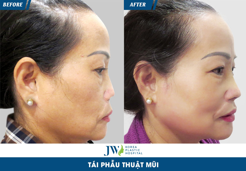 sửa mũi hỏng tphcm