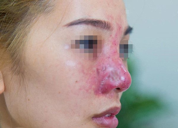 sửa mũi hỏng tphcm