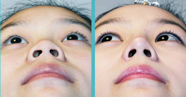 bác sĩ thu gọn cánh mũi đẹp tphcm
