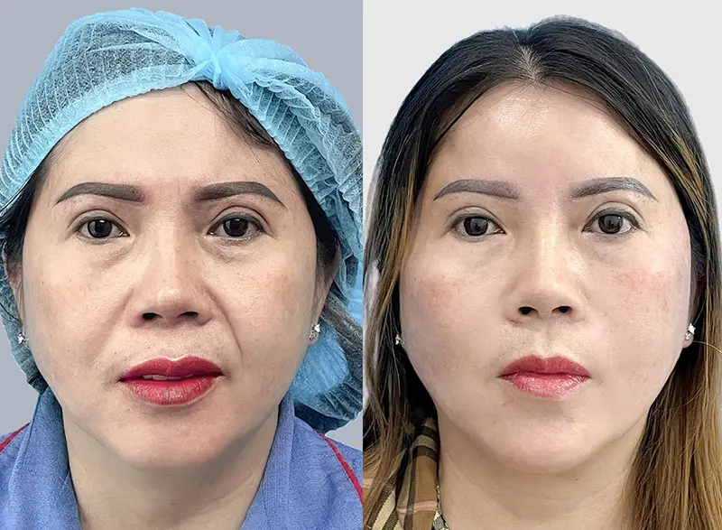 Căng da mặt tphcm