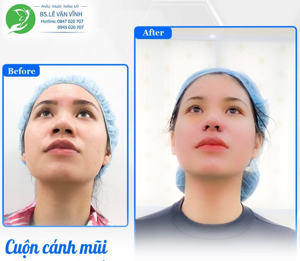 Cuộn cánh mũi có để lại sẹo không