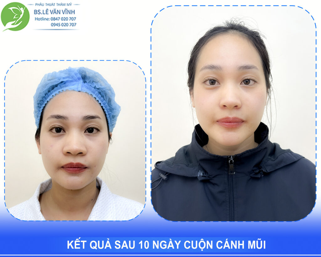 Kết quả cuộn cánh mũi có để lại sẹo hay không