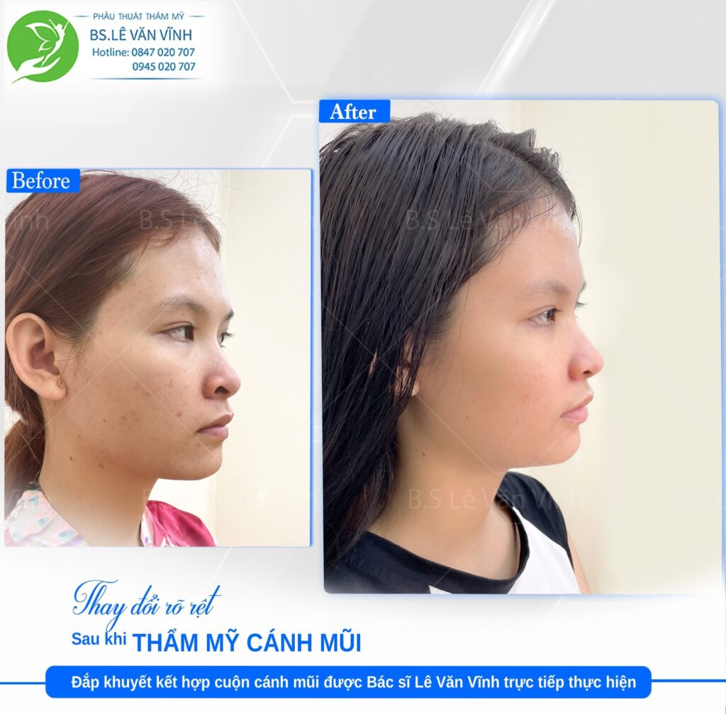 Ghép khuyết cánh mũi