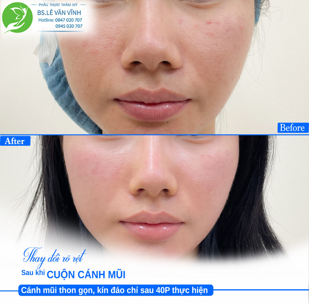 Cuộn cánh mũi đẹp