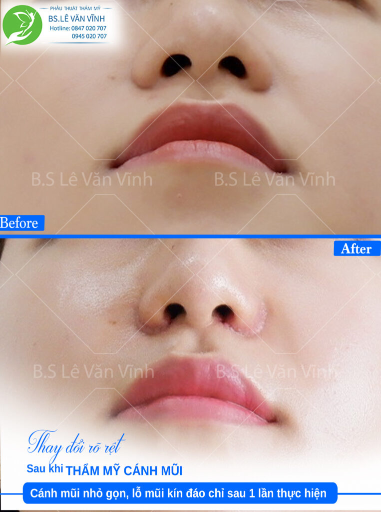 Cuộn cánh mũi kín