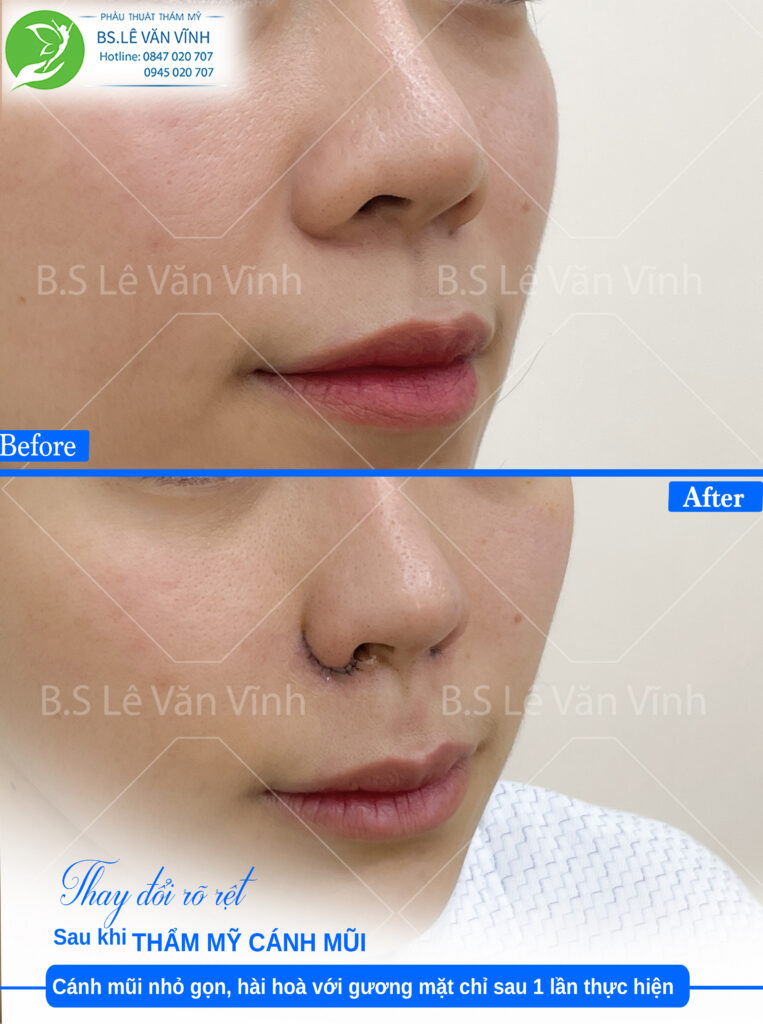 Cuộn cánh mũi nữ