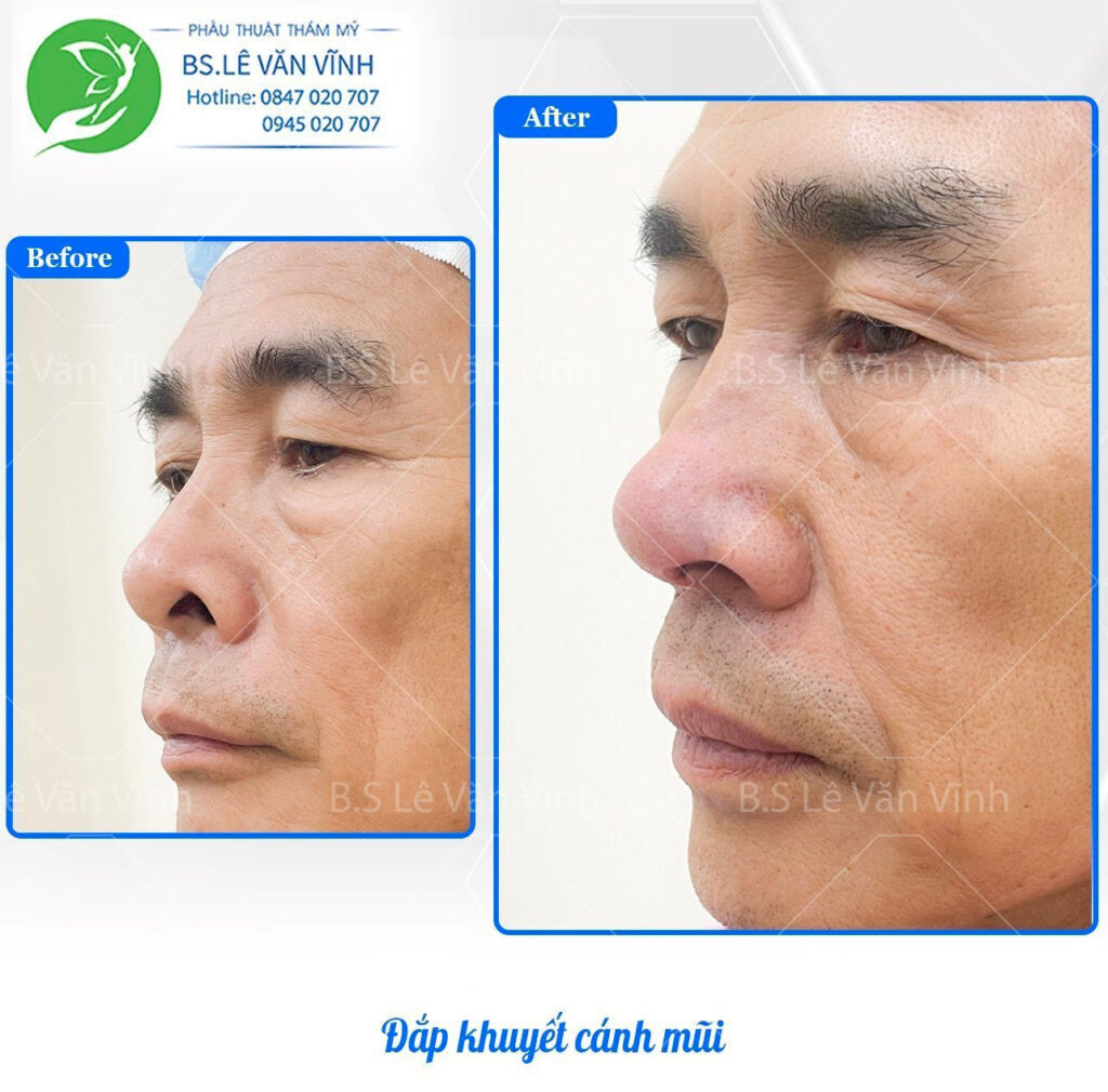 Đắp khuyết cánh mũi