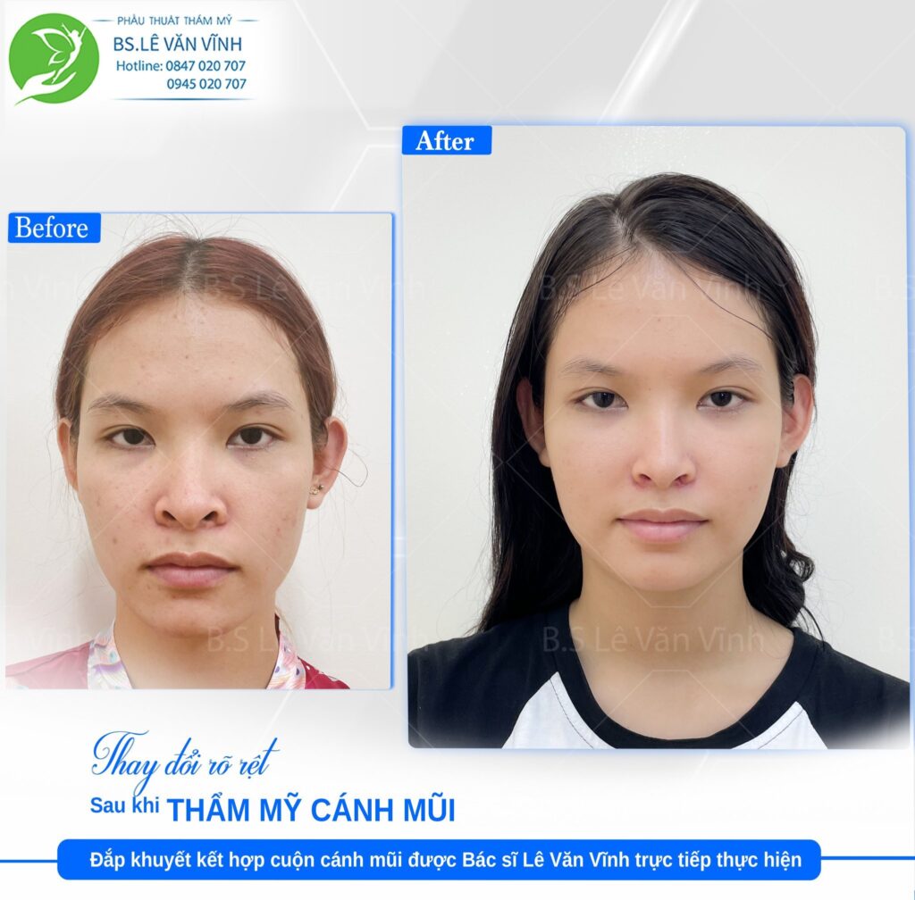 Đắp khuyết cánh mũi