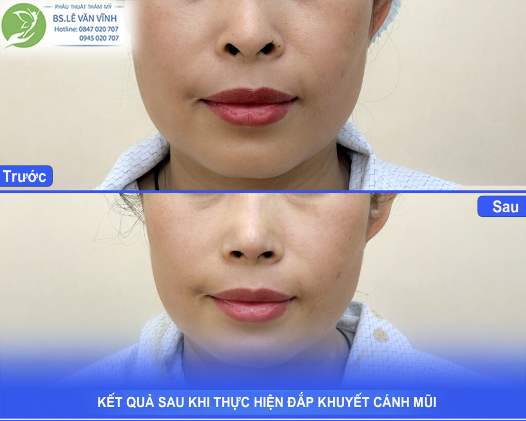 đắp khuyết cánh mũi