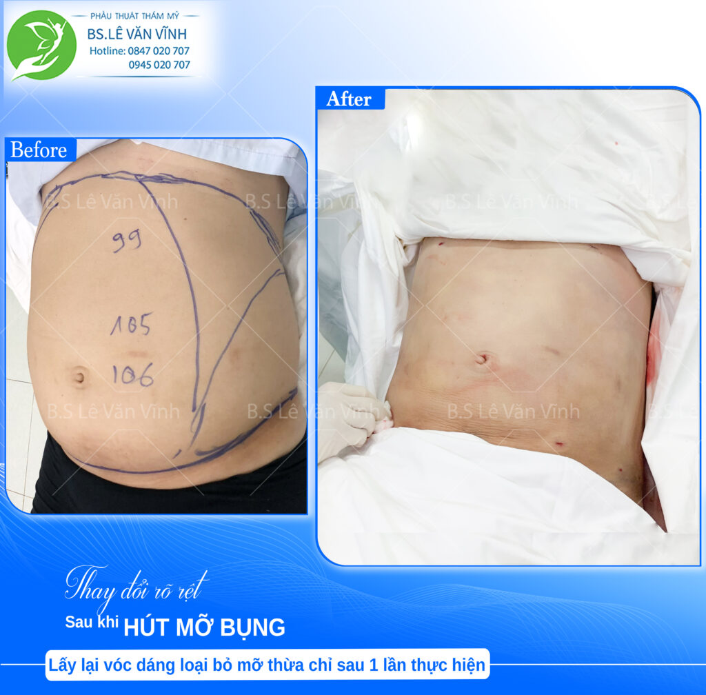 kết quả hút mỡ bụng nam sau thực hiện