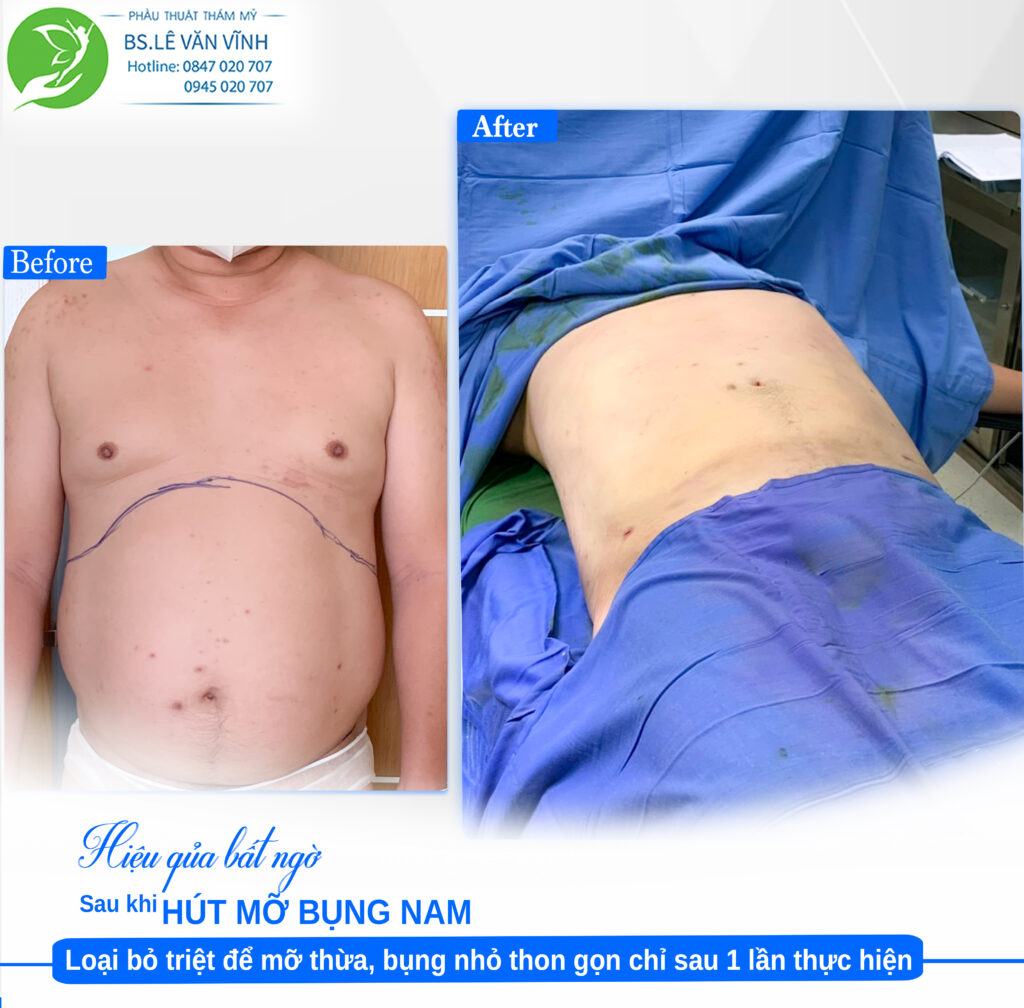 kết quả hút mỡ bụng nam