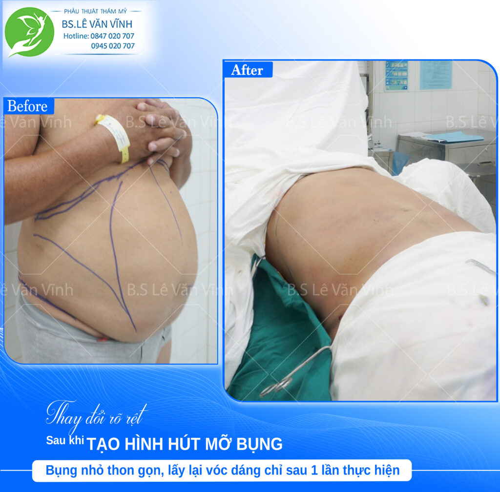 khách hàng nam bụng bia trước và sau hút mỡ bụng