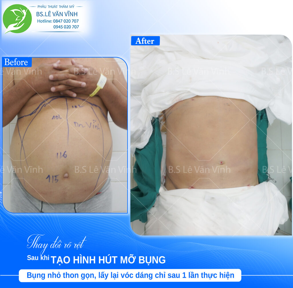 Kết quả trước sau hút mỡ bụng nam – vòng bụng thon gàng