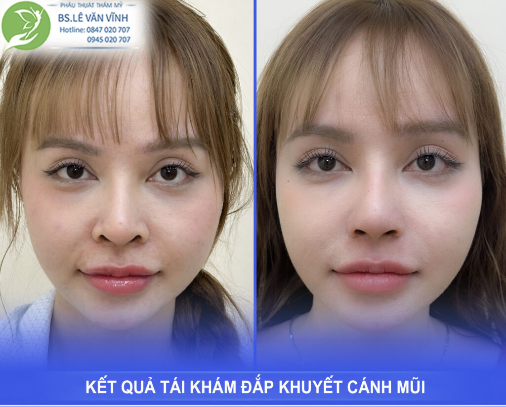 Kết quả tái khám đắp khuyết cánh mũi