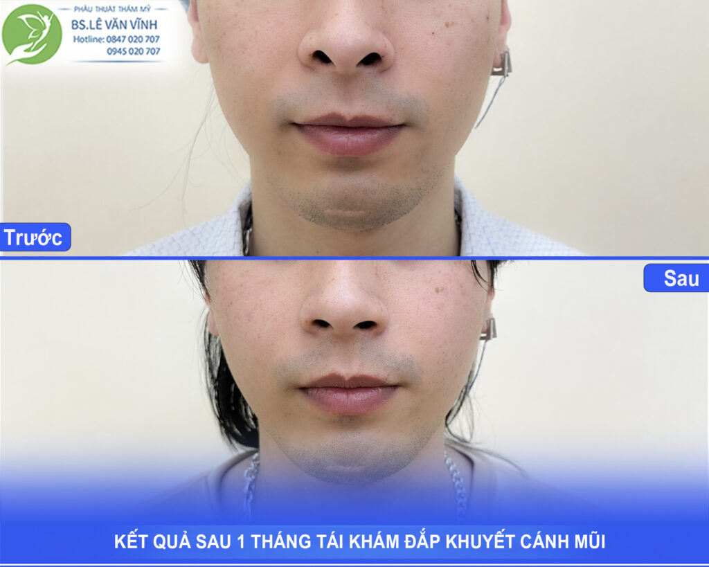 Kết quả tái khám đắp khuyết cánh mũi