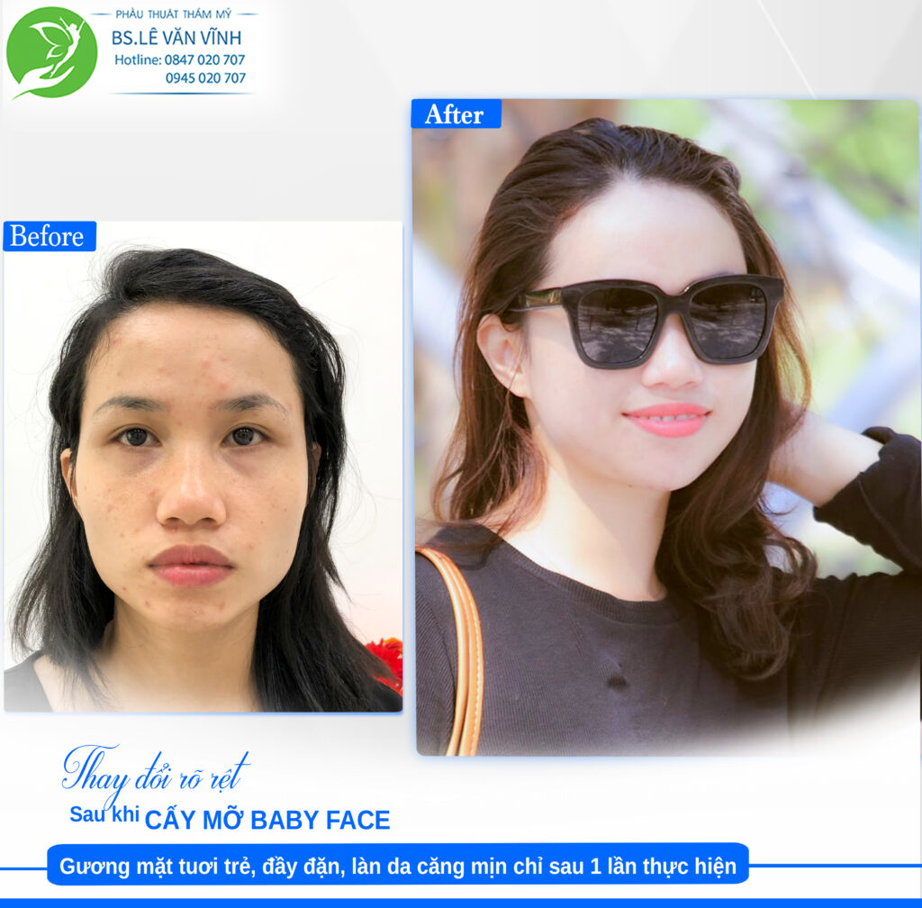 Cấy mỡ Babyface Bs Lê Văn Vĩnh