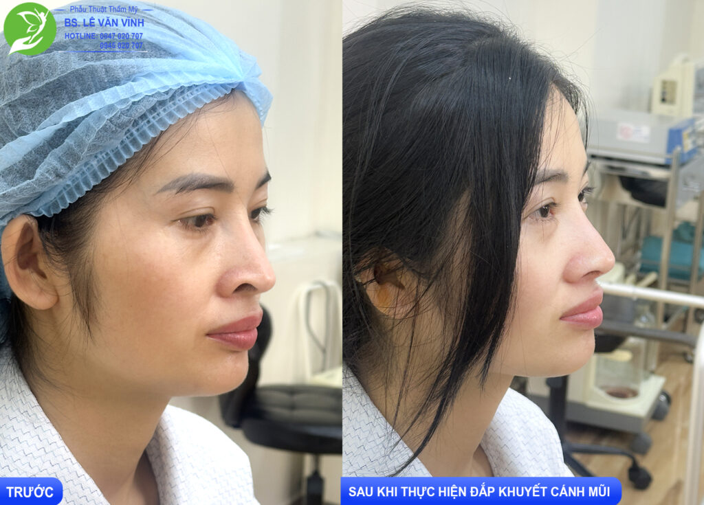 Kết quả đắp khuyết cánh mũi