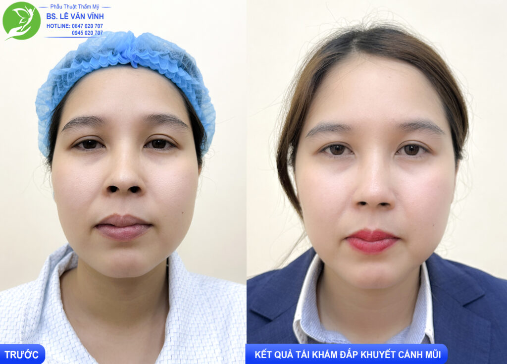 Tái khám đắp khuyết cánh mũi