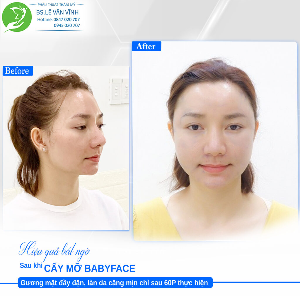 Cấy mỡ Babyface Bs Lê Văn Vĩnh