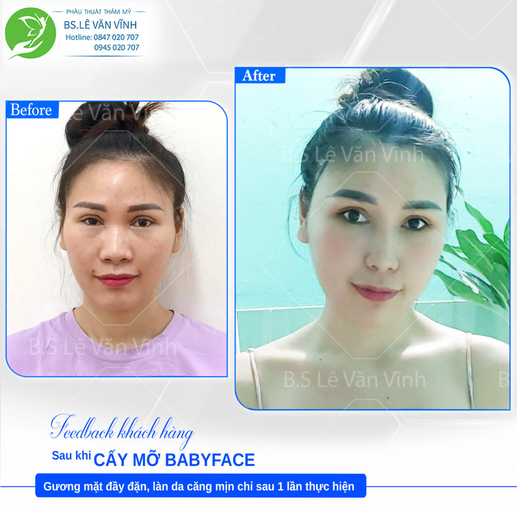 Cấy mỡ Babyface Bs Lê Văn Vĩnh