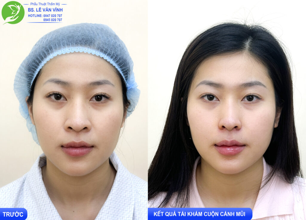 Cuộn cánh mũi do Bác sĩ Lê Văn Vĩnh thực hiện