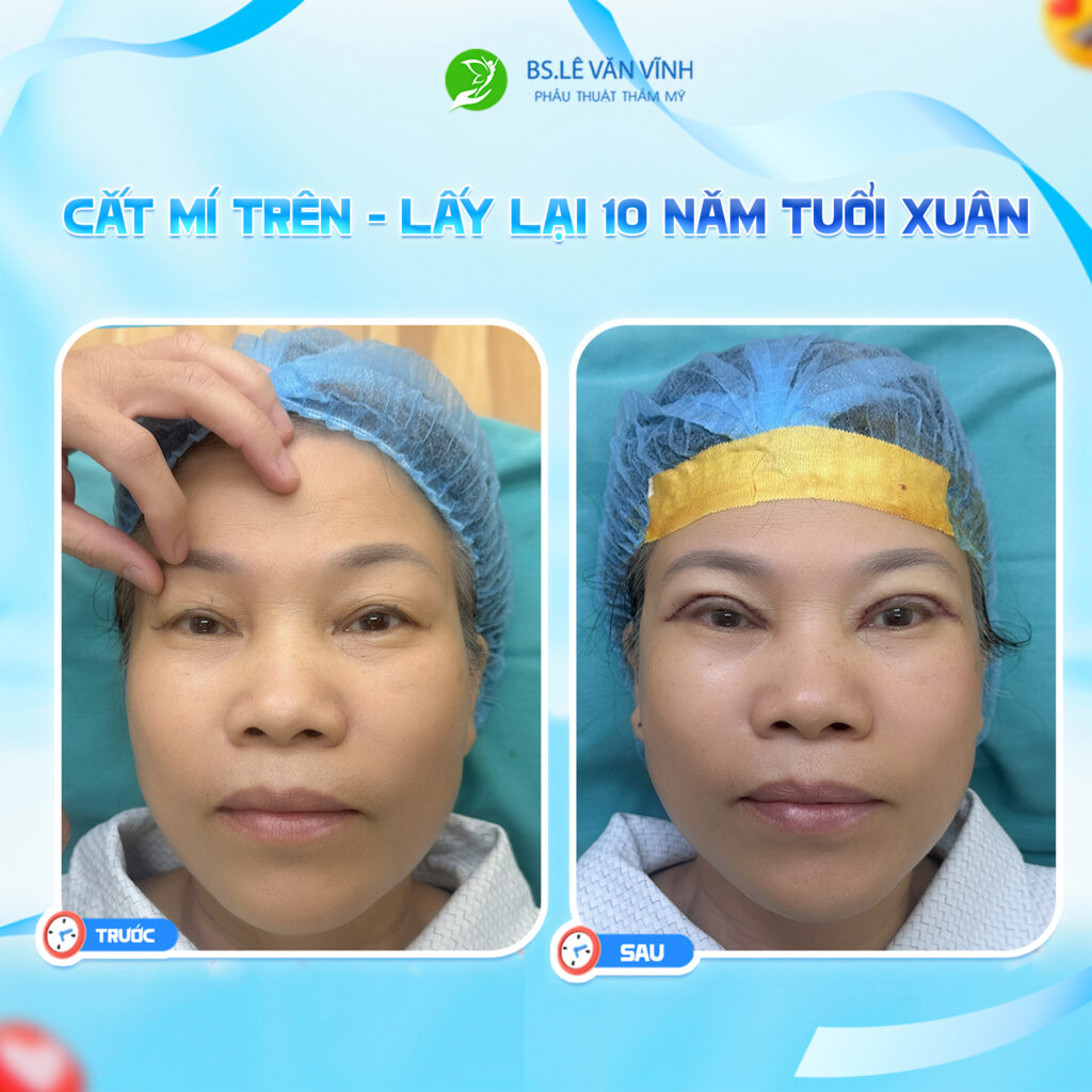 Cắt mí trên thực hiện bởi Bác sĩ Lê Văn Vĩnh