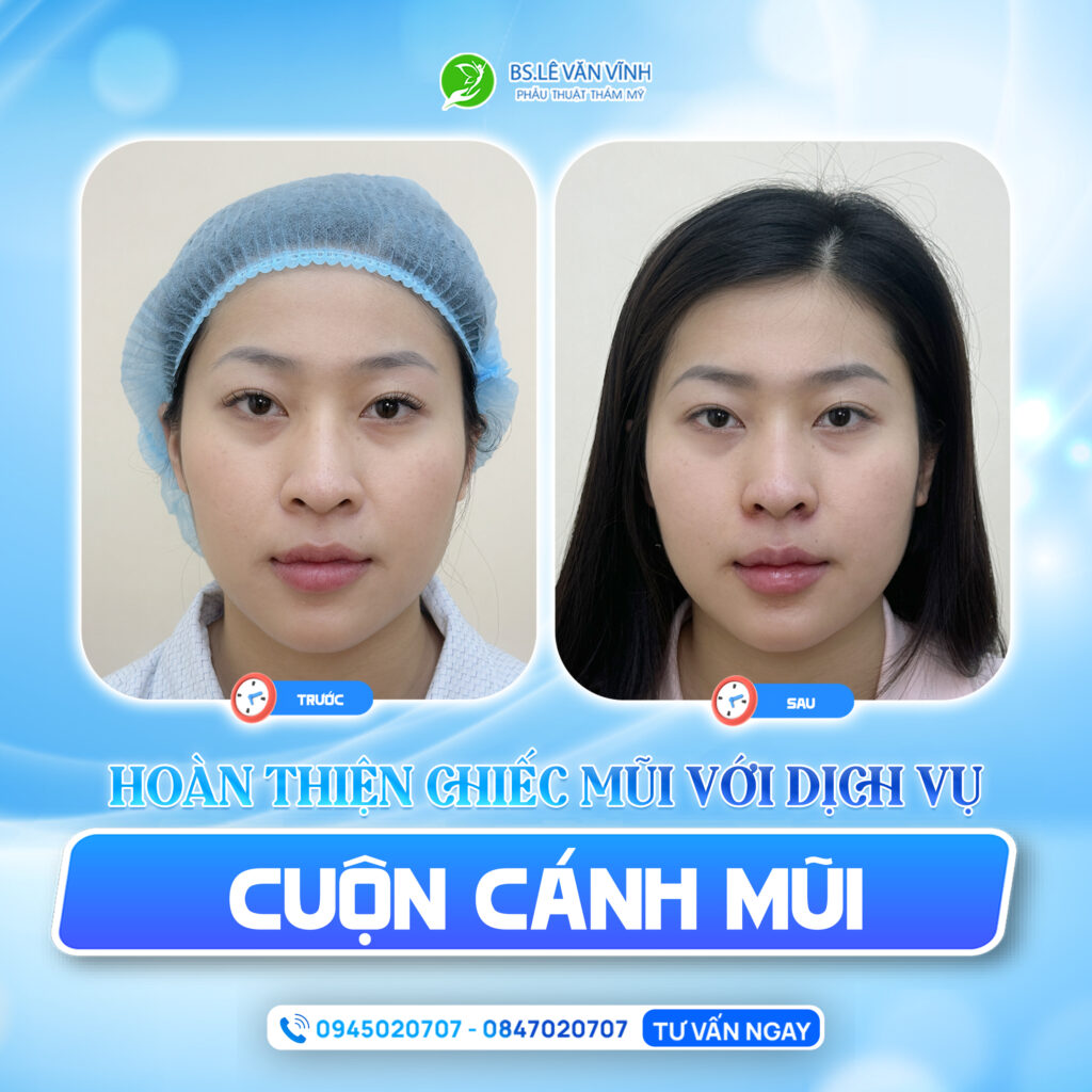 Thu gọn cánh mũi do Bác sĩ Lê văn Vĩnh thực hiện