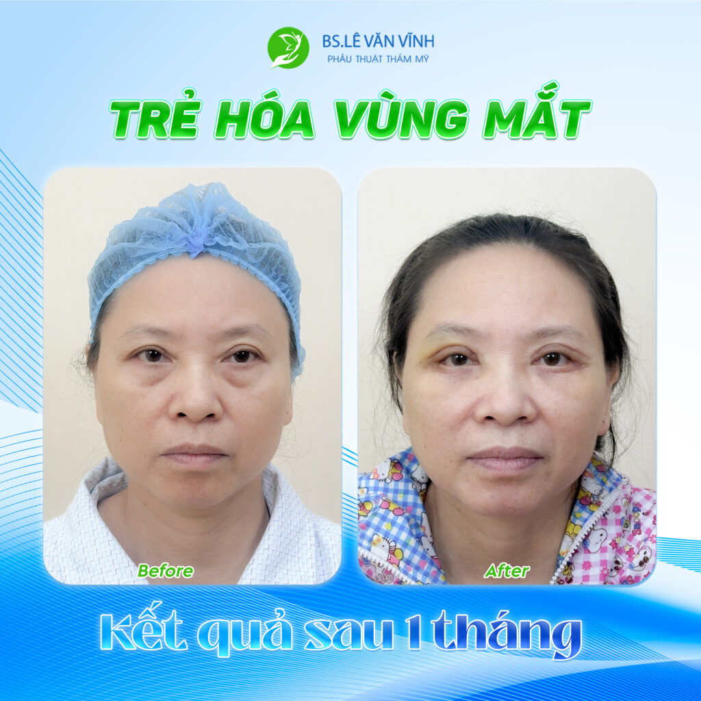 Trẻ hóa đôi mắt do Bác sĩ Lê Văn Vĩnh thực hiện