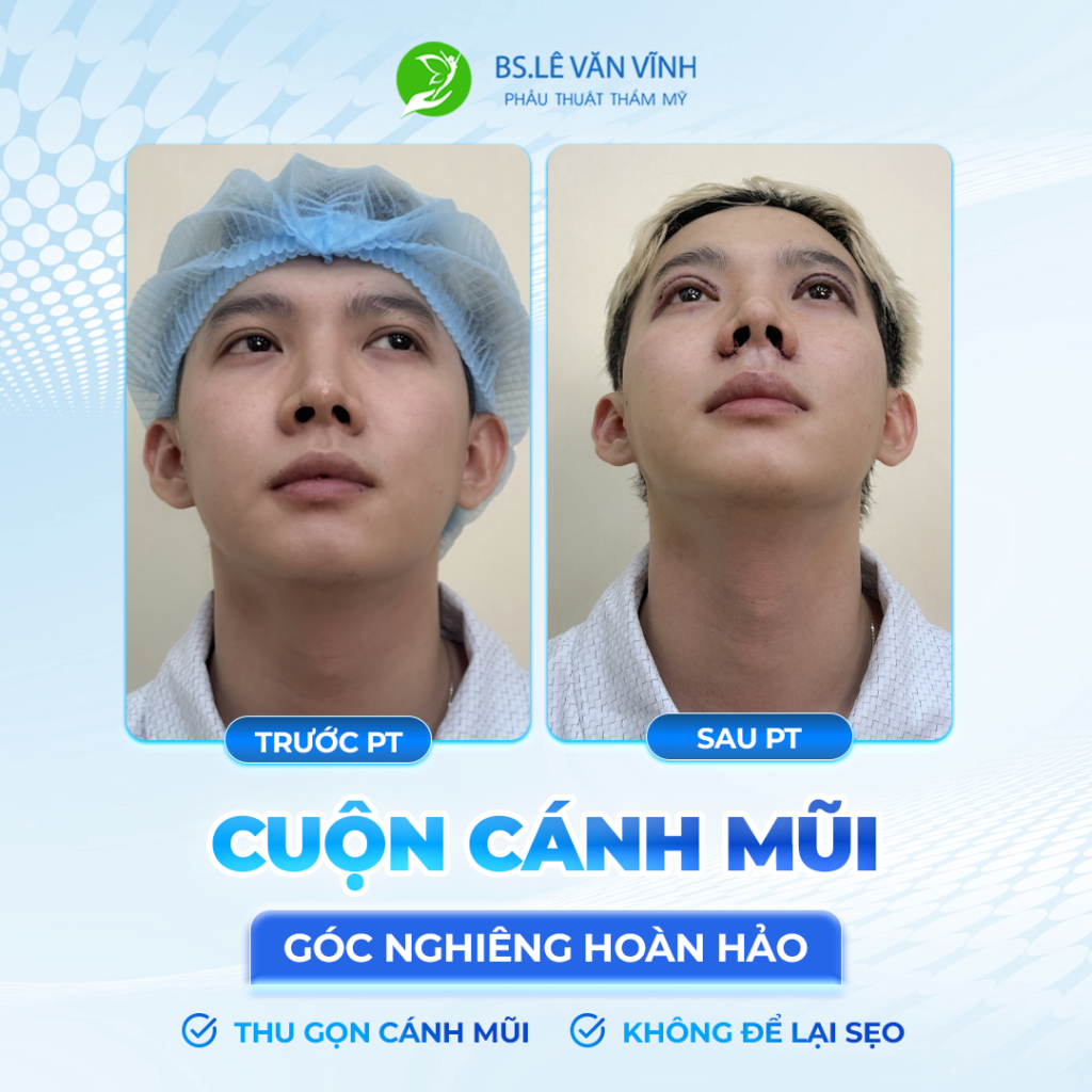 Thu gọn cánh mũi do Bác sĩ Lê văn Vĩnh thực hiện