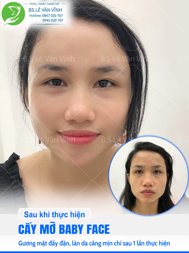 Cấy mỡ BabyFace Bác sĩ Lê Văn Vĩnh
