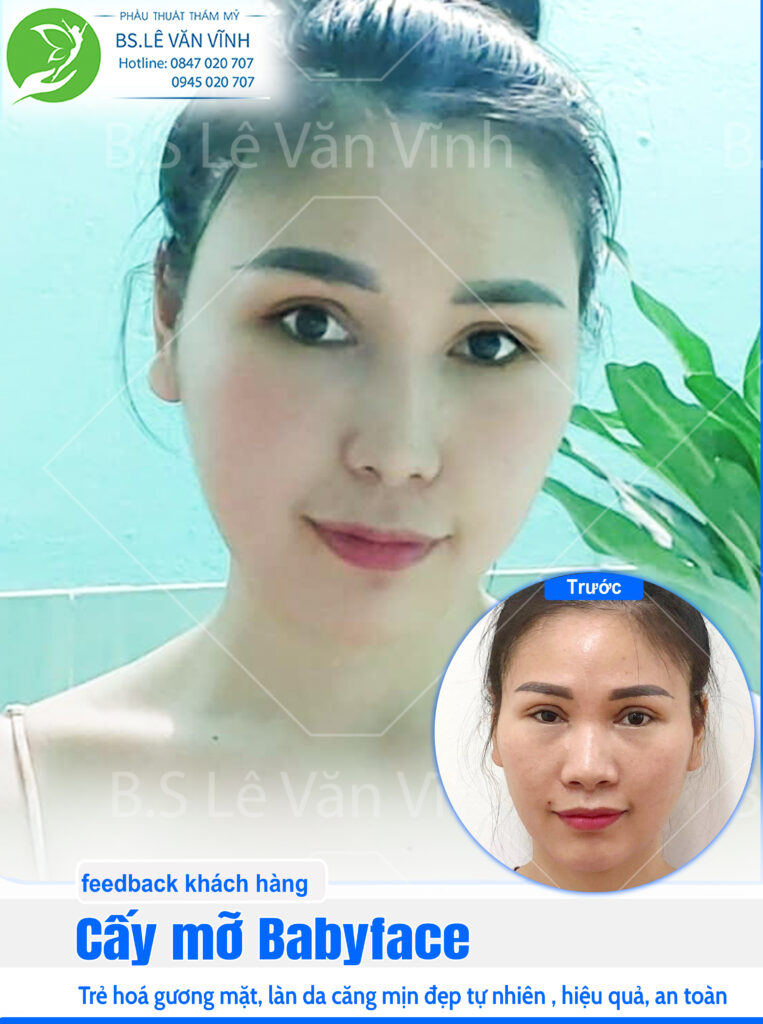 Cấy mỡ BabyFace bác sĩ Lê Văn Vĩnh