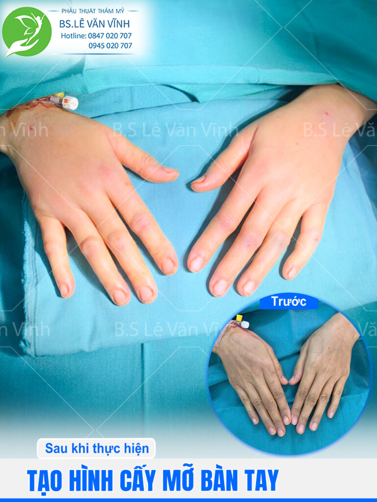 Cấy mỡ bàn tay Bác sĩ Lê Văn Vĩnh