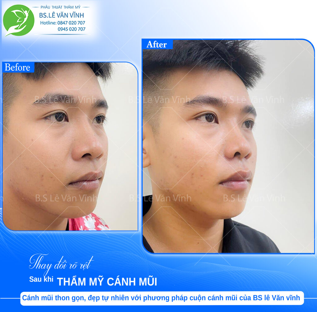 Cuộn cánh mũi do Bác sĩ Lê Văn Vĩnh thực hiện