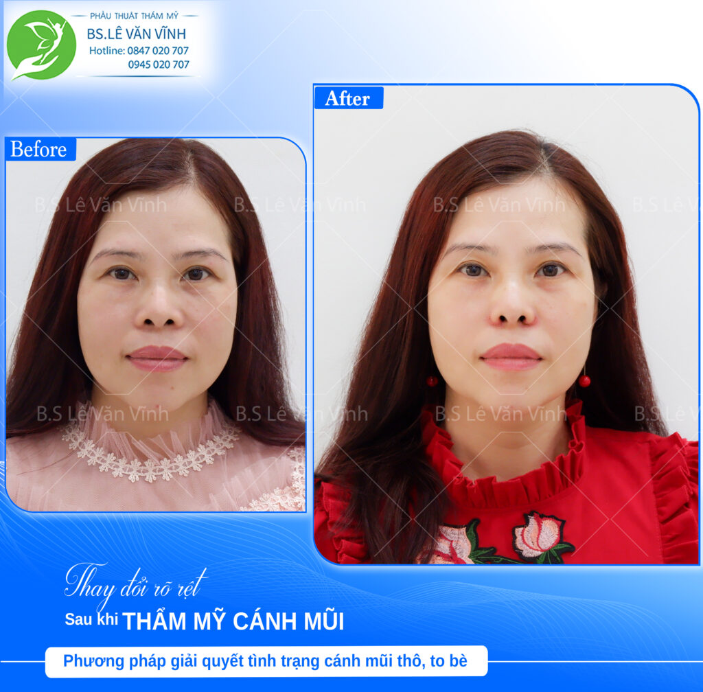Cuộn cánh mũi do Bác sĩ Lẻ Văn Vĩnh thực hiện