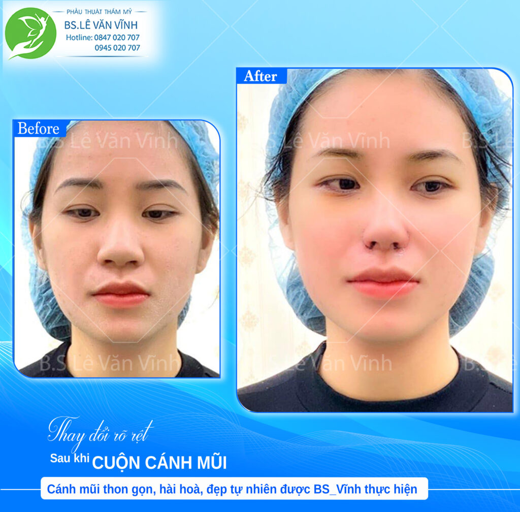 Cuộn cánh mũi do Bác sĩ Lê Văn Vĩnh thực hiện