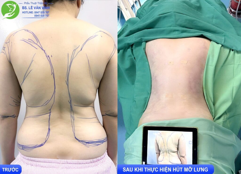 Hút mỡ thực hiện bởi Bác sĩ Lê Văn Vĩnh