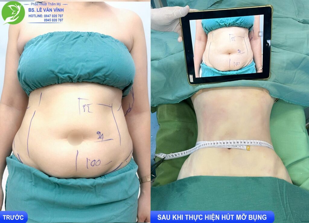 Hút mỡ bụng thực hiện bởi Bác sĩ Lê Văn Vĩnh