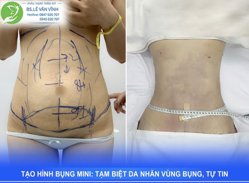 Hút mỡ bụng thực hiện bởi Bác sĩ Lê Văn Vĩnh