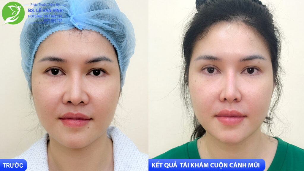 Cuộn cánh mũi do Bác sĩ Lê Văn Vĩnh thực hiện